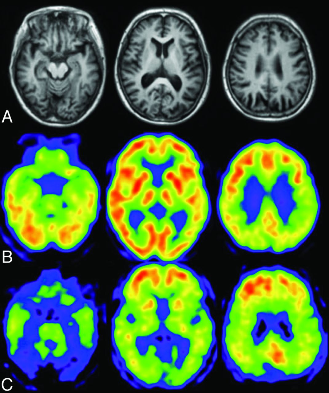 Alzheimer Detection with CNNs